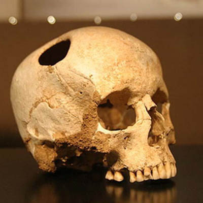 Человеческий череп: часть черепной коробки удалена